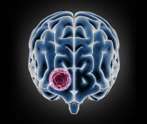 هل عملية استئصال الورم خطيرة؟