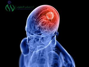 طرق تشخيص ورم المخ