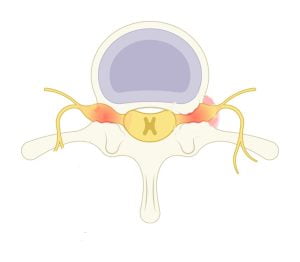 أسباب توسيع القناة العصبية 