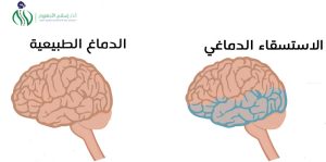 الاستسقاء الدماغي