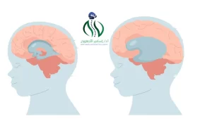 طرق تشخيص الاستسقاء الدماغي