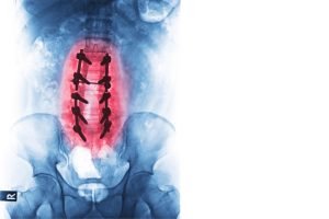 مؤشرات نجاح عملية تثبيت الفقرات القطنية