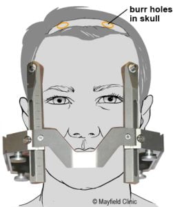 ما هو التحفيز العميق للدماغ في مصر 