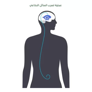 علاج تسرب السائل النخاعي