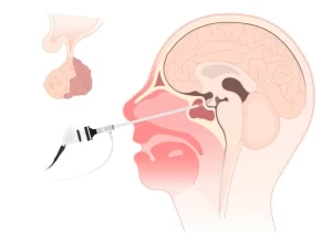 جراحات الغدة النخامية بالمنظار