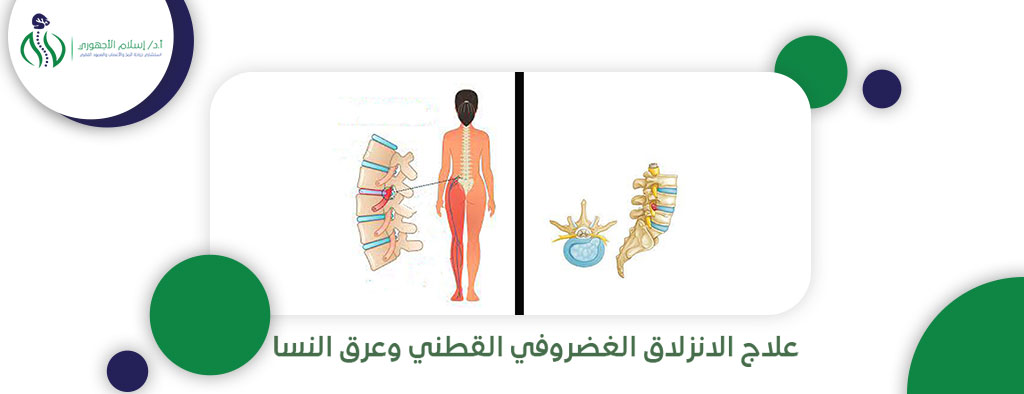 علاج الانزلاق الغضروفي القطني وعرق النسا