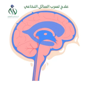 علاج تسرب السائل النخاعي