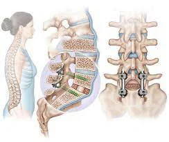 مدة الشفاء من عملية تثبيت الفقرات