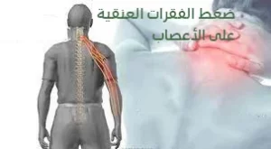 ضغط الفقرات العنقية على الأعصاب