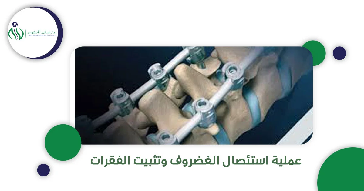 عملية استئصال الغضروف وتثبيت الفقرات