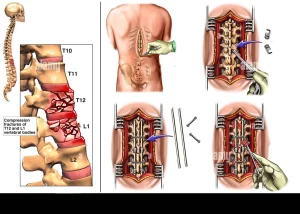 كيفية إجراء عملية استئصال الغضروف وتثبيت الفقرات بالمنظار