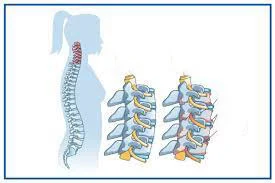 ما هي أمراض الفقرات العنقية؟