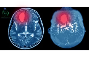 تشخيص أورام المخ و الأعصاب