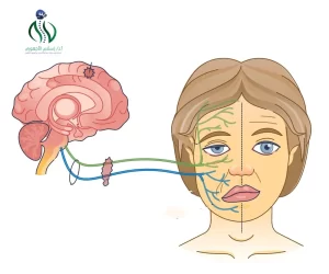 أسباب حدوث شلل العصب الوجهي