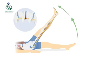 أسباب عرق النسا 