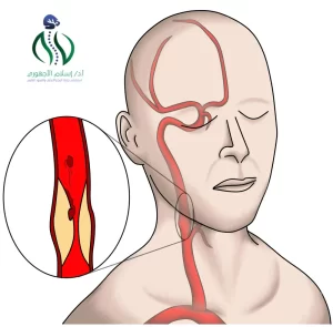 أعراض ضيق الشريان السباتي