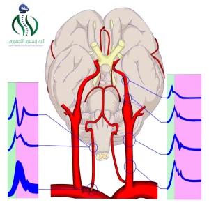 أفضل دكتور علاج ضيق الشريان السباتي