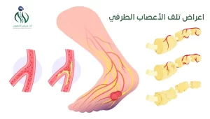 اعراض تلف الأعصاب الطرفي 