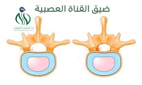 ما هو ضيق القناة العصبية؟