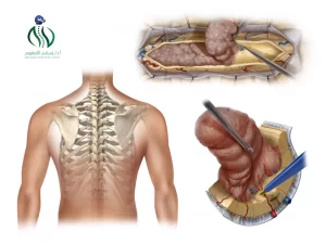 نسبة نجاح عملية استئصال ورم في النخاع الشوكي