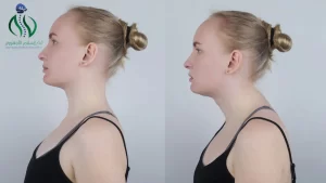 أعراض إصابة الفقرة c1 وc2