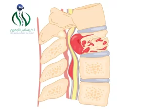 عملية إزالة ورم من العمود الفقري