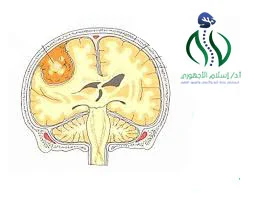 ما هي عملية استئصال الورم السحائي
