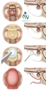 إجراءات عملية ترقيع قاع الجمجمة بالمنظار