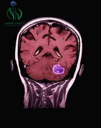 تشخيص ورم قاع الجمجمة