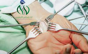 شكل اليد بعد عملية تسليك العصب