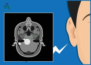 عملية ورم العصب السمعي