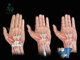 ما بعد عملية تسليك عصب اليد بالمنظار