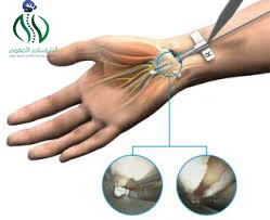 شكل اليد بعد عملية تسليك العصب
