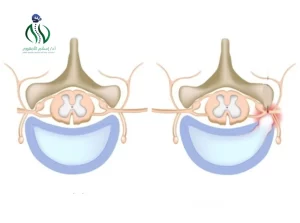 درجات الإنزلاق الغضروفي