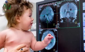 أنواع أورام الدماغ عند الأطفال