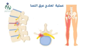 طرق تشخيص الأصابة بعرق النسا
