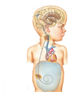 علاج استسقاء الدماغ عند الرضع